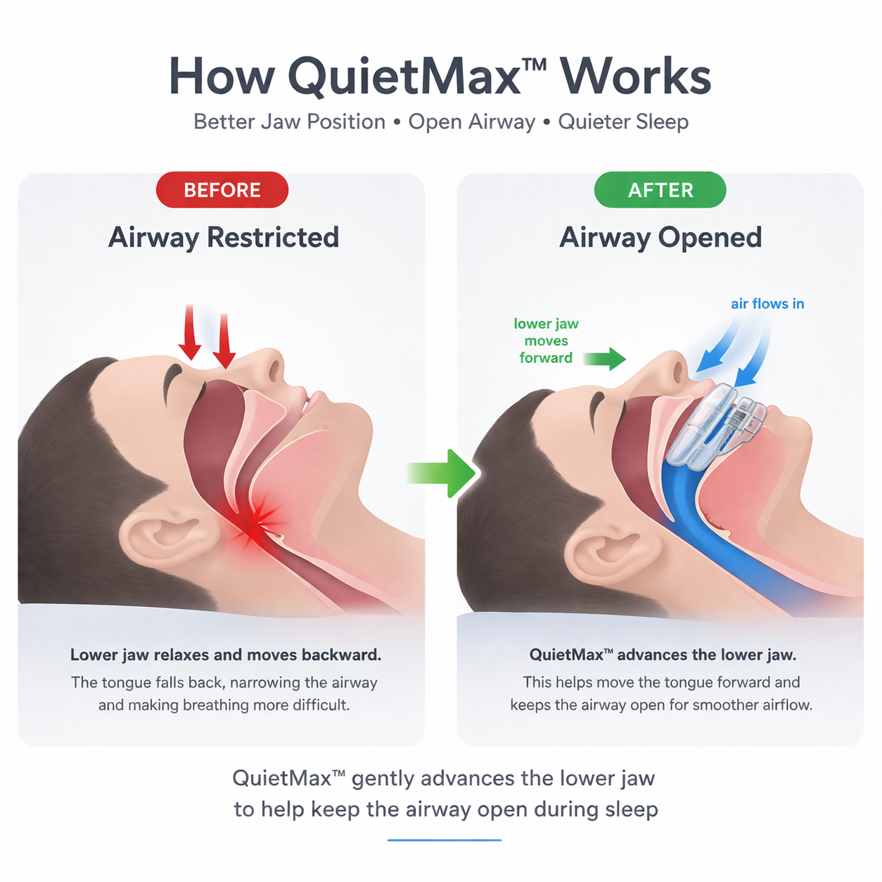 QuietMax™ – Adjustable Anti-Snoring Mouthpiece